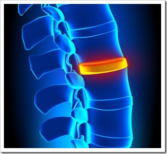 Herniated Disc and Back Pain Clinton MS